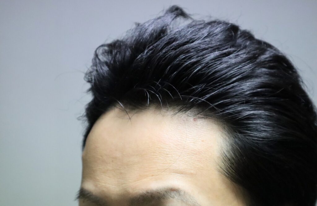 AGAヘアクリニックで用いられる薬の注意点