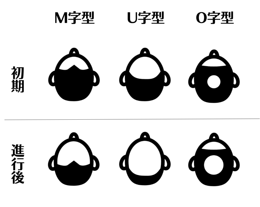 若ハゲの進行パターン